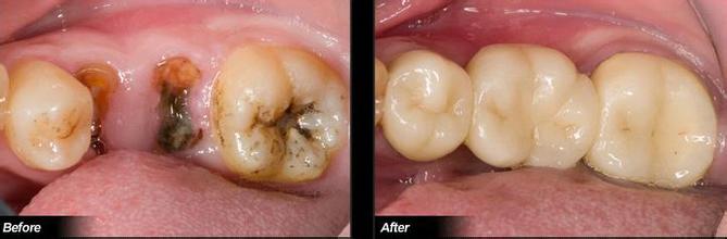 蛀牙的根管治疗,中医治疗蛀牙