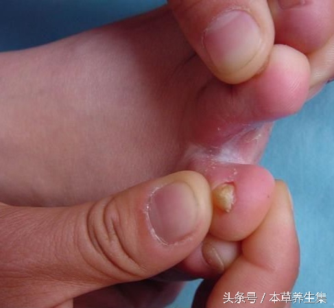 男性14岁趾间糜烂型脚气脱皮现象,脚上脱皮水泡痒脚趾缝溃烂