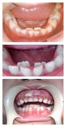 为什么会长两层牙,孩子换牙为两层牙图片