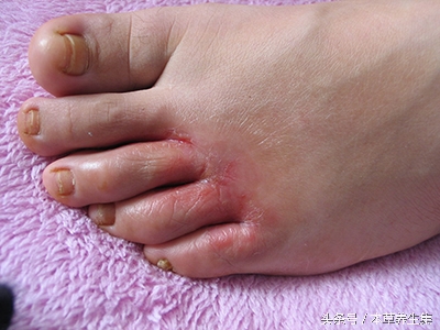 男性14岁趾间糜烂型脚气脱皮现象,脚上脱皮水泡痒脚趾缝溃烂