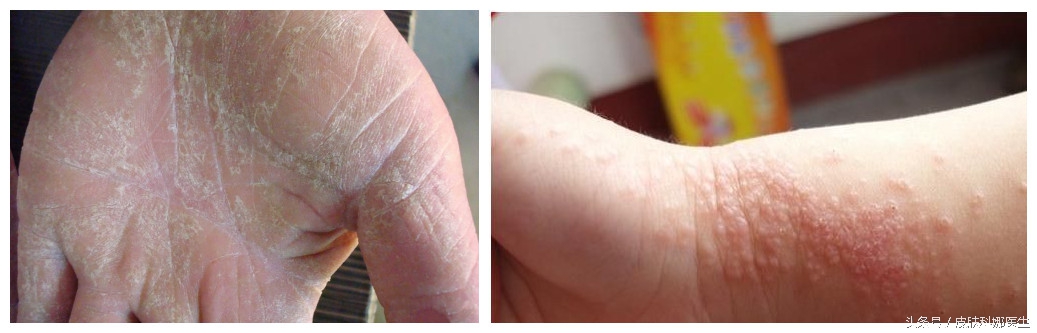 皮肤发红发痒可以用碘伏吗,皮肤瘙痒起红疹子可以吃什么水果