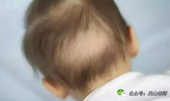 宝宝后脑勺爱出汗睡觉易醒,宝宝睡觉后脑勺出汗是缺钙吗