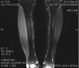 肩周炎中频电疗处方,颈椎病理疗中频电疗