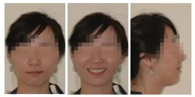 牙齿矫正是拔牙多好还是少好,为什么牙齿矫正一般都要拔牙