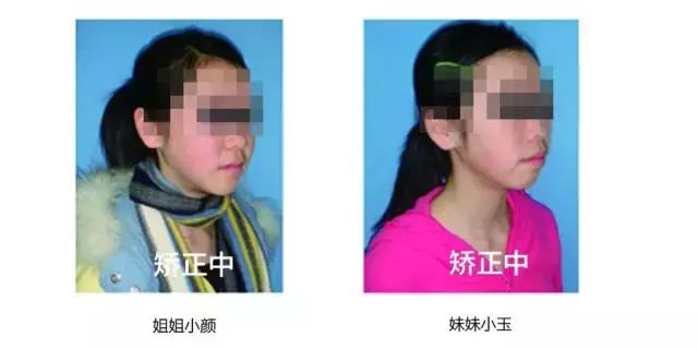 牙齿矫正是拔牙多好还是少好,为什么牙齿矫正一般都要拔牙