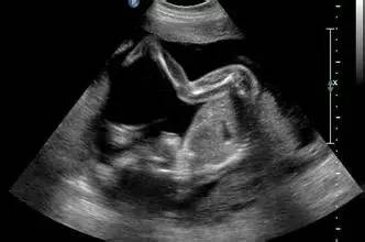 胎儿11-14周心脏检查超声图片,12-14周孕期检查重要项目