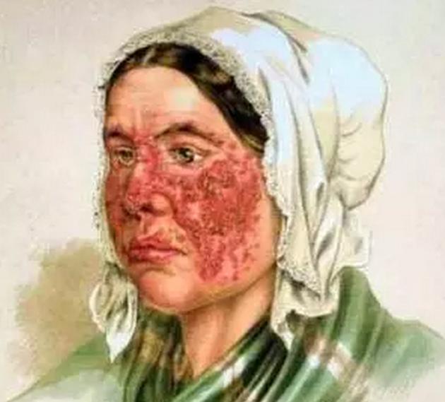 红斑狼疮肾炎怀孕了要关注什么,红斑狼疮吃三颗激素药可以怀孕吗