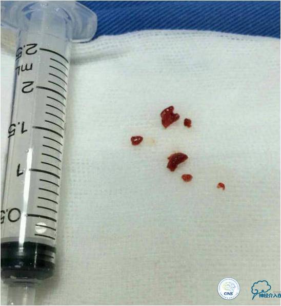 冠状动脉慢性闭塞的介入治疗,颅外段锥动脉狭窄的介入治疗