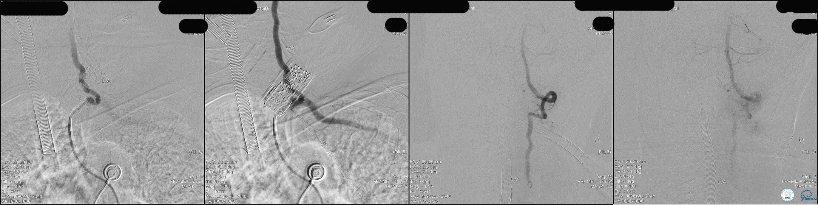 冠状动脉慢性闭塞的介入治疗,颅外段锥动脉狭窄的介入治疗