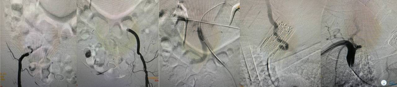 冠状动脉慢性闭塞的介入治疗,颅外段锥动脉狭窄的介入治疗