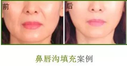 鼻唇沟太浅了,面瘫为什么会鼻唇沟加深