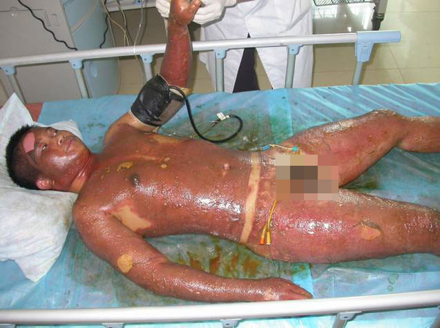 火灾后遗症解决方案,火灾后遗症怎么治疗