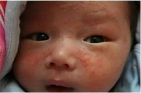 给0-3岁宝宝治疗湿疹最好用的方法都在这儿了！