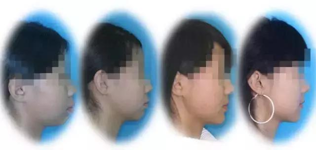 牙齿矫正是拔牙多好还是少好,为什么牙齿矫正一般都要拔牙