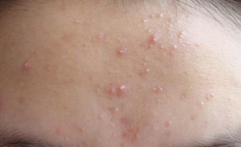 为什么粉刺突然长出来了,时不时冒出来的粉刺其实是什么