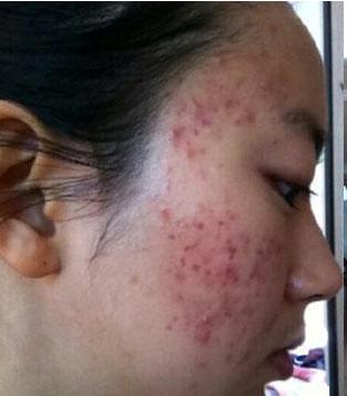 去除红色痘印最好的方法,脸蛋痘印红色是什么原因