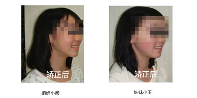 牙齿矫正是拔牙多好还是少好,为什么牙齿矫正一般都要拔牙