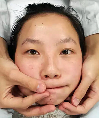 偏瘫嘴部歪训练,歪嘴改善动作