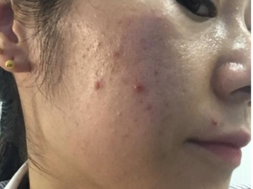 青春期怎么祛痘痘简单方法,青春痘快速祛痘方法