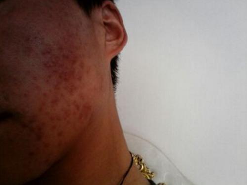 青春期怎么祛痘痘简单方法,青春痘快速祛痘方法