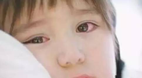 6岁娃游泳后眼睛发红怎么办,儿童游泳后眼睛充血是什么原因