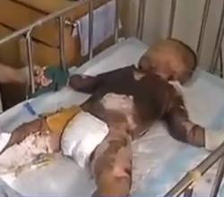 男童被米汤烫伤后续,男童被开水烫伤的表现