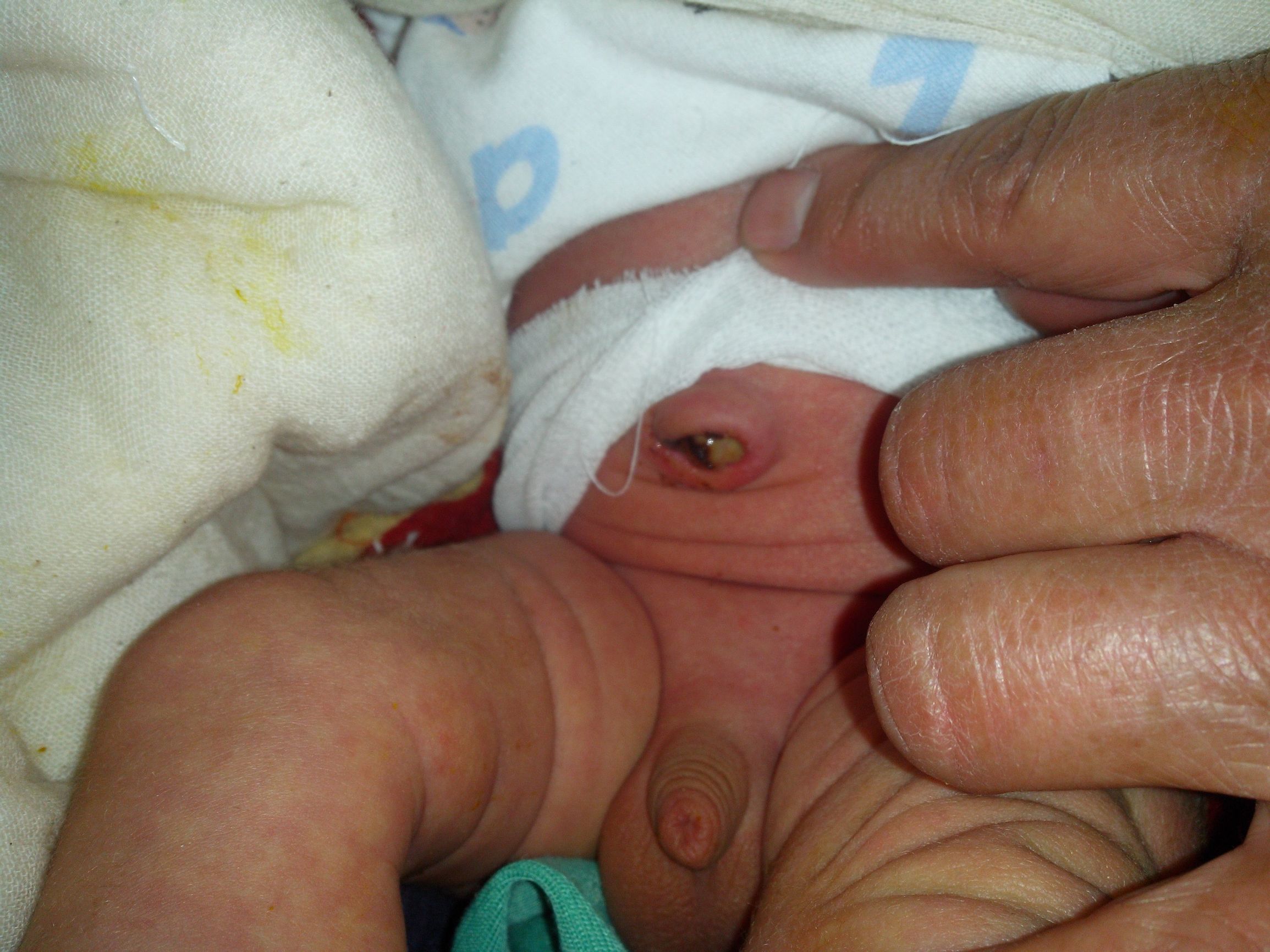 怎样预防新生儿脐炎,新生儿脐炎预防护理新进展