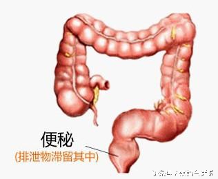 便秘烦恼孕期,孕期便秘很难缠