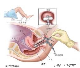 子宫检查报告单如何看,妇科子宫颈刮片是怎么检查的