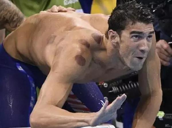 奥运会拔罐效果,里约奥运会拔火罐图