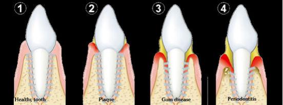 便宜洗牙对牙有害吗,洗牙有害牙齿健康吗