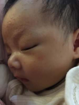 湿疹反复发作代表没找出病因吗,婴儿湿疹的诱发原因