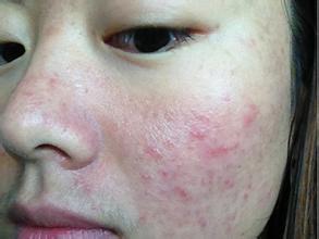 去除红色痘印最好的方法,脸蛋痘印红色是什么原因