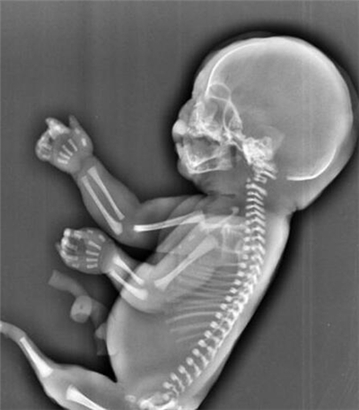 孕妈妈意外怀孕,孕妇怀孕意外发现怀了个双胞胎