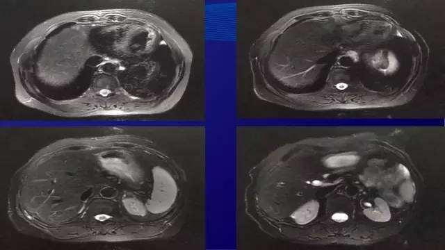 肠癌肝转移同时性和异时性,邢宝才治疗肠癌肝转移成功病例