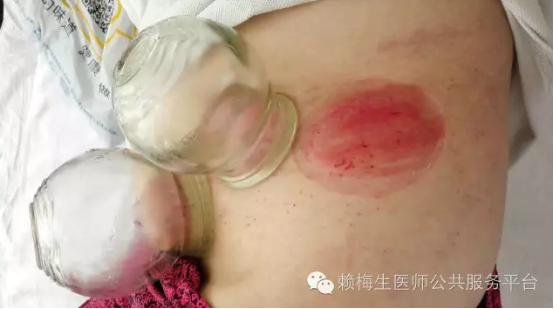 董氏奇穴治疗带状疱疹后遗症,董氏奇穴全身痒