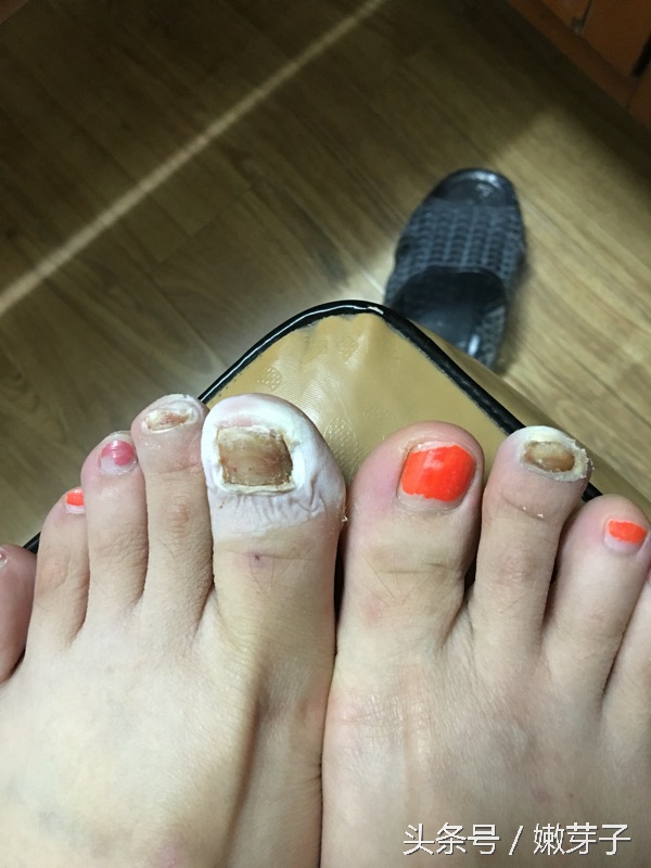 治疗灰指甲过程中需忌口吗,治灰指甲有几个阶段