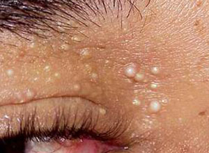 眼睛周围长出的这些小米粒儿，到底是什么呢？