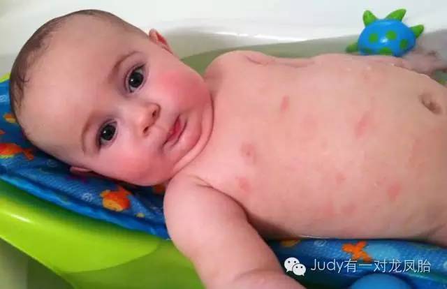 崔玉涛儿童湿疹,儿科专家崔玉涛湿疹