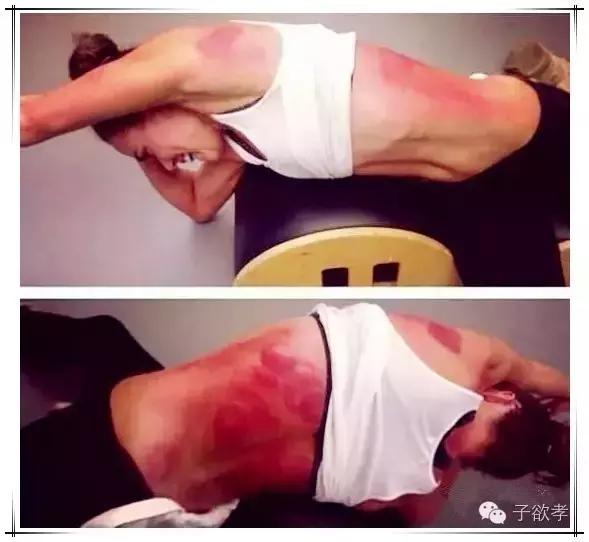 里约奥运会开幕式点燃火炬,里约奥运会拔火罐