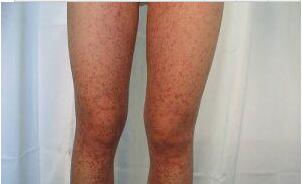 湿疹是不是春天高发,湿疹经常做这些事好得快