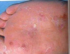 孕妇脚气可以用百肤宁吗,孕妇脚气有什么小妙招