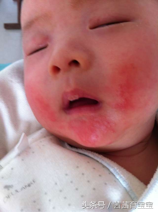 宝宝长湿疹涂什么药膏,宝宝喝奶长湿疹怎么办