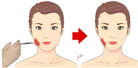 瘦脸针不适合什么病人,中年人适合打瘦脸针吗