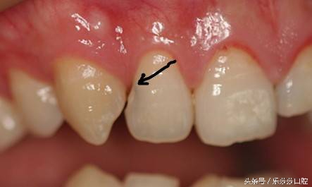 牙缝里卡了小小的鱼刺怎么拔出来,牙缝深处的菜叶怎么弄出来