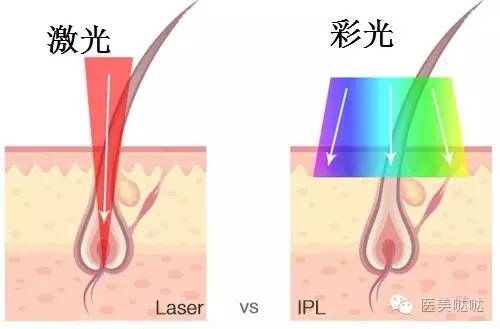 家用脱毛仪怎么选？看这几个指标就行了！