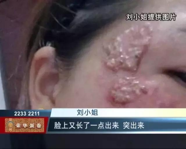 药水祛斑毁容能恢复吗,药水祛斑的后遗症