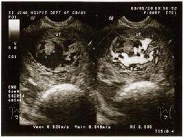 怀孕6周出血b超看不到,怀孕六周查不到孕囊出血了