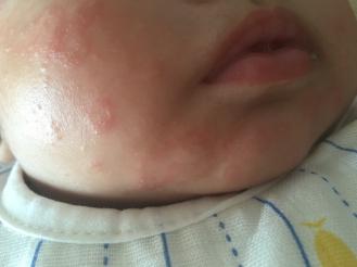 婴儿湿疹奶癣怎么护理,新生儿奶癣跟湿疹可以擦保湿霜吗