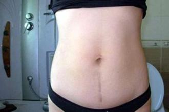 剖宫产夏天坐月子的关注事项,剖宫产夏天怎么坐月子